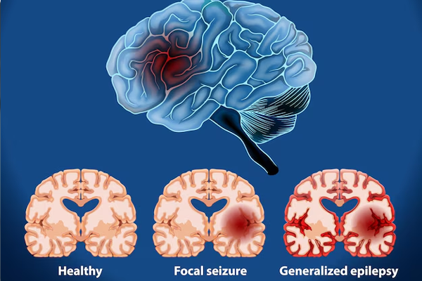Epilepsy Disorders