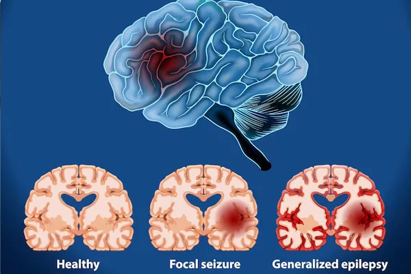 Epilepsy Disorders