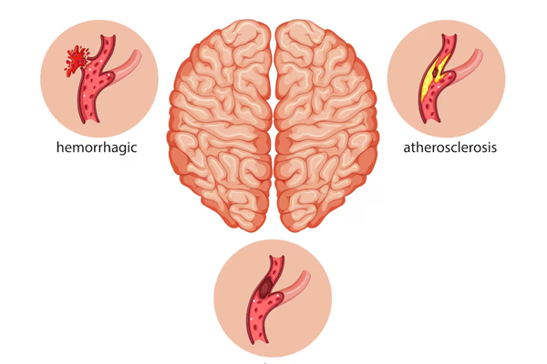 Acute Stroke